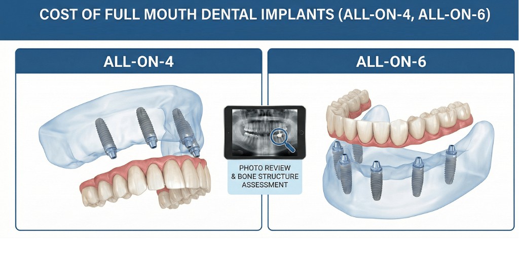 Cost of full mouth dental implants All-on-4 All-on-6 diagram